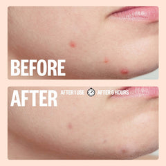 Peace Out Salicylic Acid Acne Healing Dots (20 Dots)