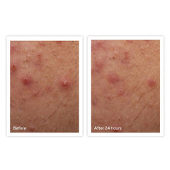 Murad Rapid Relief Acne Spot Treatment 0.5 oz