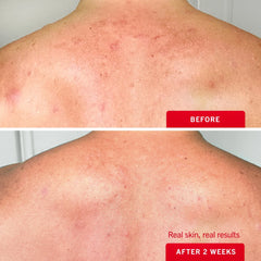 First Aid Beauty Soothing Acne Body Spray 2% Salicylic Acid Acne Treatment 90ml