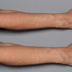 Perricone MD Cold Plasma Plus+ Fragile Skin Therapy
