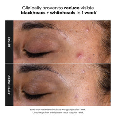 Paula's Choice Skin Perfecting 2% BHA Liquid Exfoliant (118ml)