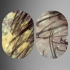 Act+Acre Scalp Relief System (Worth $182.00)
