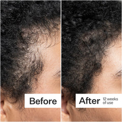 Act+Acre Scalp Dermastamp for Thicker + Fuller Looking Hair