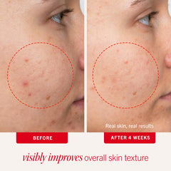 First Aid Beauty Clearing Daily Acne Pads 2% SA Acne Treatment