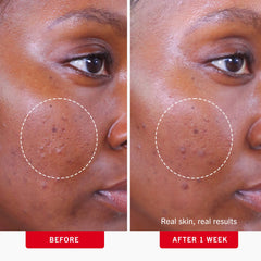 First Aid Beauty Clearing Daily Acne Pads 2% SA Acne Treatment