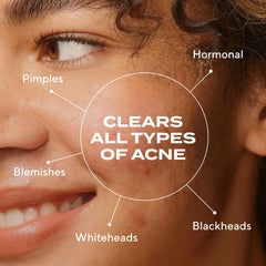 Murad Biome-Balancing Clear & Prevent Acne Treatment Serum 30ml