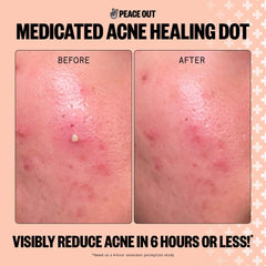Peace Out Salicylic Acid Acne Healing Dots (20 Dots)