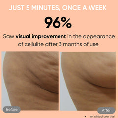 Sensica Sensifirm RF for Cellulite