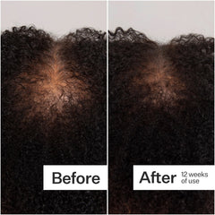 Act+Acre Scalp Dermastamp for Thicker + Fuller Looking Hair