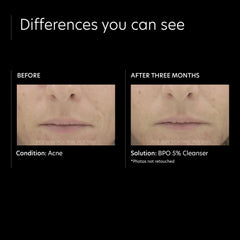 PCA SKIN BPO 5% Cleanser (7 oz.)