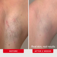 First Aid Beauty Ingrown Hair Pads 28 Ct.