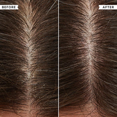 Flaky Scalp Cleansing Shampoo 1000ml
