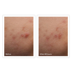Murad Rapid Relief Acne Spot Treatment 0.5 oz