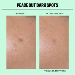 Peace Out Microneedling Dark Spot Brightening (12 Dots)